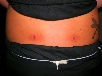 lower back dermals