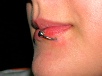 spider bite viper bite