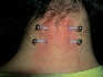 surface piercing, nape piercing